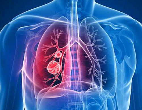 肺气肿会传染吗 肺气肿饮食的禁忌有哪些