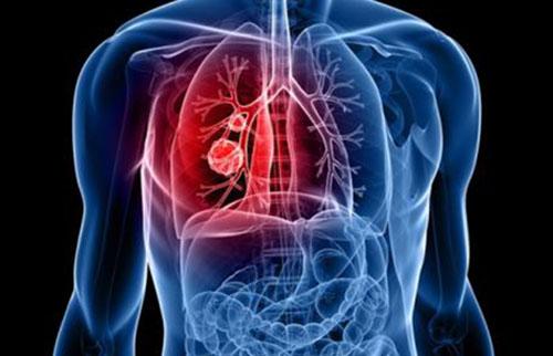 怎样预防肺癌 怎样预防肺癌的发生最佳方法