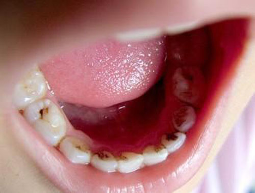龋齿有什么症状 牙齿龋齿症状
