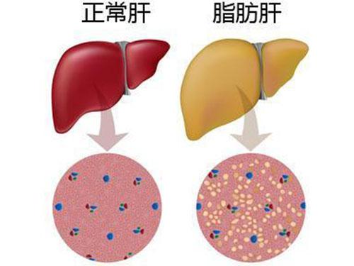 脂肪肝怎么调理 脂肪肝怎么调理饮食