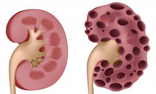 肾囊肿有哪些症状 肾囊肿有哪些症状表现