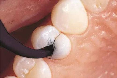 龋齿怎么形成 龋齿是什么原因造成的