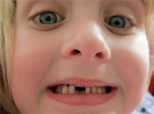 小孩换牙半年还没长出来为什么 小孩换牙齿半年没长出来