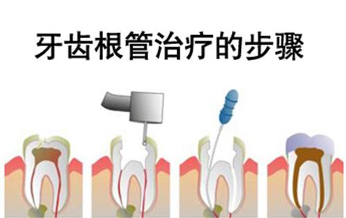 龋齿根管治疗怎么做 龋齿根管治疗步骤