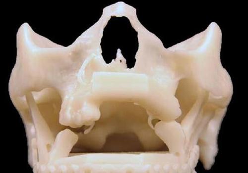颌骨骨折的临床表现 颌骨骨折常见的临床体征