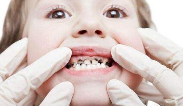 如何保护牙齿预防蛀牙 如何保护牙齿预防蛀牙的方法