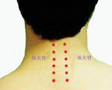 颈椎病针灸穴位图（颈椎病针灸的部位图）