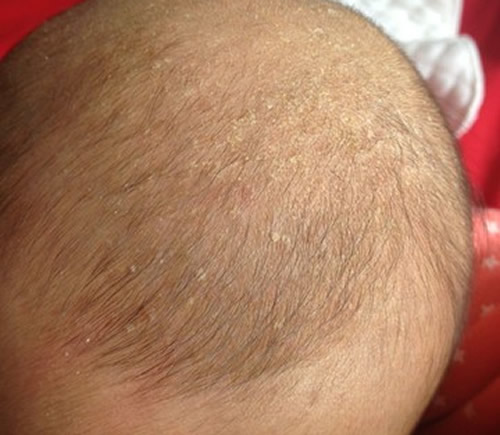 婴儿头上的头垢是怎么形成的 婴儿头上的头垢是什么