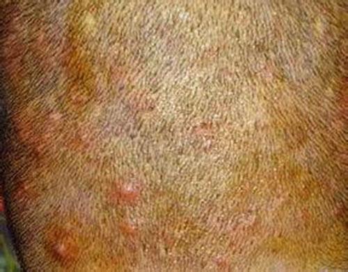 头皮上长痘痘是什么原因 头皮上长痘痘是什么原因按上去痛