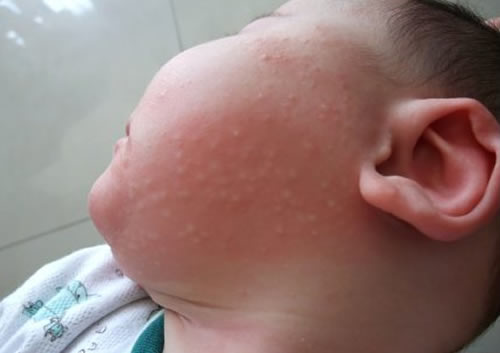 宝宝吃奶粉过敏的症状 奶粉过敏症状