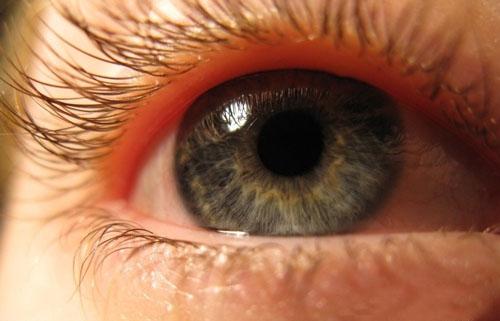 眼睛酸痛是什么原因 睡醒后眼睛酸痛是什么原因