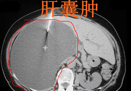 肝囊肿是怎么回事（肝囊肿是怎么回事需要治疗吗）