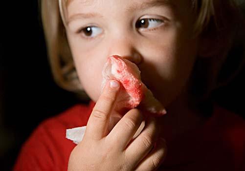 小孩流鼻血是什么原因 小孩流鼻血是什么原因引起的呢?夏天