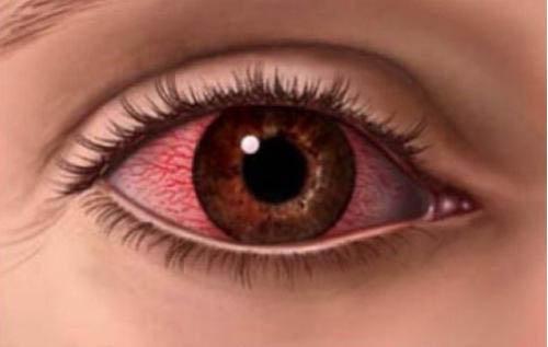 眼睛充血是什么原因 老年人眼睛充血是什么原因