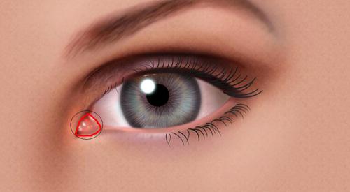 眼睛内眼角肉团状的东西是什么 眼睛内眼角肉团状的东西是什么病