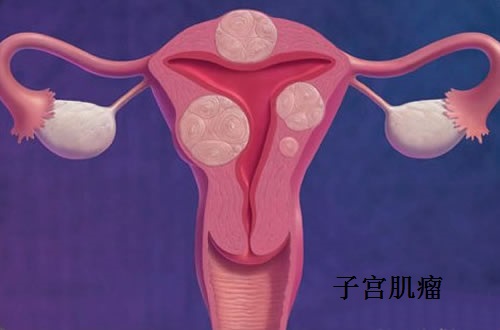 子宫肌瘤该怎么办 怀孕发现有子宫肌瘤该怎么办