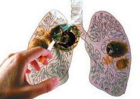 肺癌是什么原因引起的（小细胞肺癌是什么原因引起的）