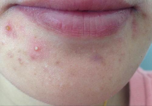 嘴唇上面长痘痘是什么原因 下巴和嘴唇上面长痘痘是什么原因