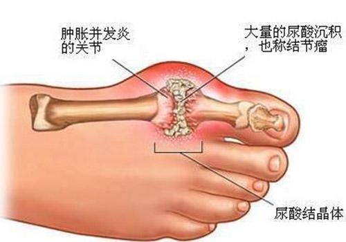 痛风用什么泡脚最好 痛风用啥泡脚好