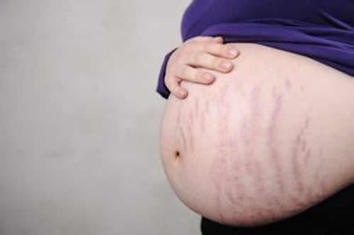 妊娠纹什么时候开始长 孕期妊娠纹什么时候开始长