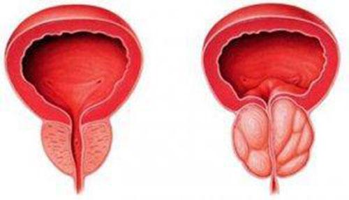 前列腺增生是怎么形成的（前列腺增生是怎么形成的请读给我）
