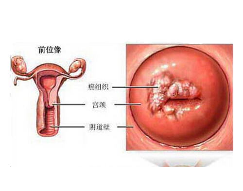 hpv病毒是什么（hpv病毒是什么症状）