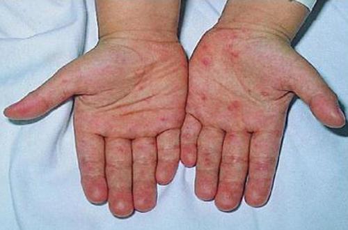 手足口病初期症状（手足口病初期症状图片及治疗法）