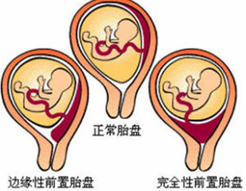 前置胎盘是怎样造成的 什么原因造成前置胎盘