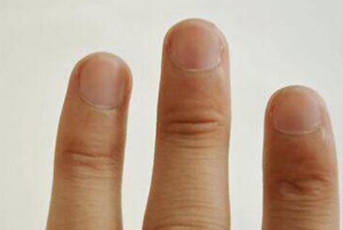 灰指甲早期症状 灰指甲早期症状及治疗