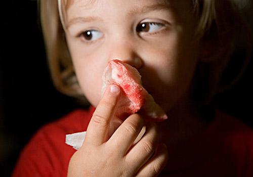 宝宝流鼻血是什么原因 七岁宝宝流鼻血是什么原因
