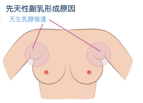 副乳的危害（男性副乳的危害）