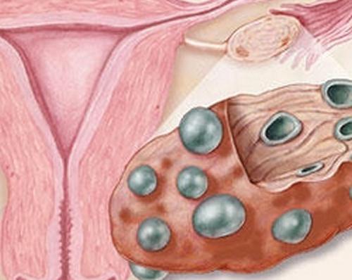 多囊卵巢可以自愈吗 多囊卵巢可以自愈吗会怀孕吗