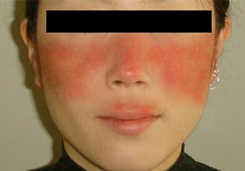 蝶形红斑与过敏的区别（蝶状红斑和皮肤过敏）