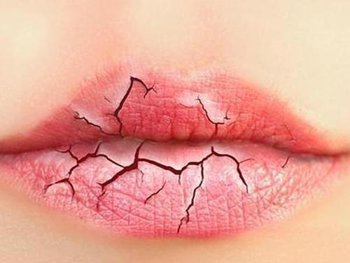 怎么预防嘴唇干裂 怎么预防嘴唇干裂的方法
