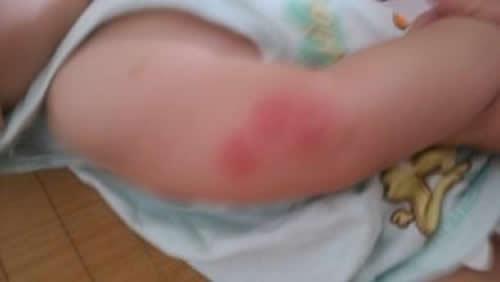 宝宝被蚊子咬后肿得很大怎么办（十个月宝宝被蚊子咬后肿得很大怎么办）