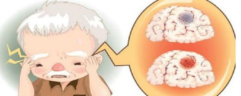脑血管意外是怎么回事 脑血管意外是什么