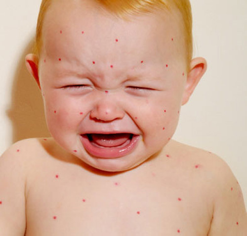 风疹的症状 宝宝出风疹的症状