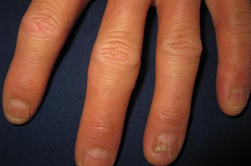 灰指甲有哪些类型 灰指甲分几种类型有图介绍一下