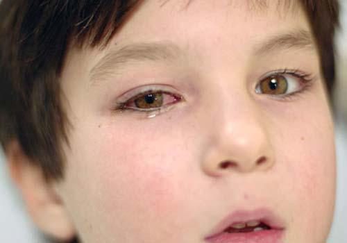 结膜炎和红眼病的区别 红眼睛和结膜炎的区别