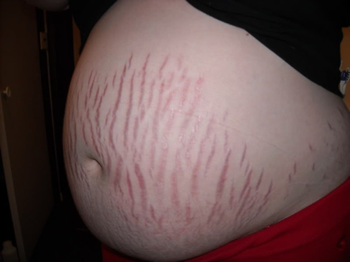 妊娠纹是怎么形成的 肚子上的妊娠纹是怎么形成的
