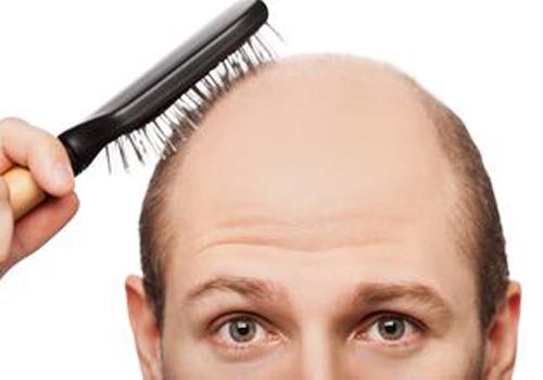 男性脱发是什么原因引起的 男性脱发是什么原因引起的怎么办