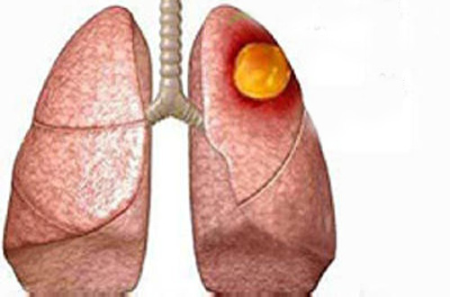 肺癌确诊需要做什么检查 肺癌需要做哪些检查确诊