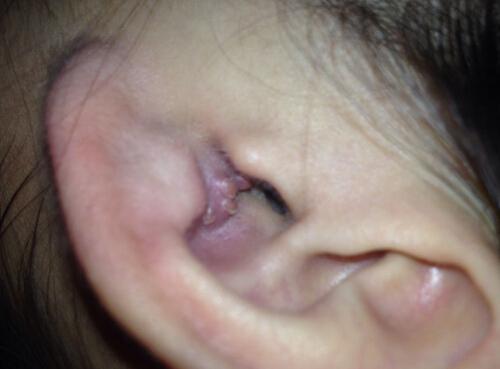 耳朵里面长了个痘痘是怎么回事 耳朵里面长了个痘是什么原因