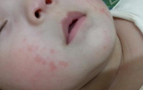宝宝湿疹的症状（宝宝湿疹的症状和治疗方法）