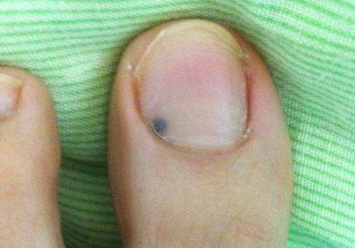 指甲上有黑点是癌症吗 指甲上有黑线是癌症吗