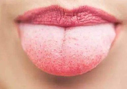 舌头发白是艾滋病吗 舌头发白是不是艾滋病