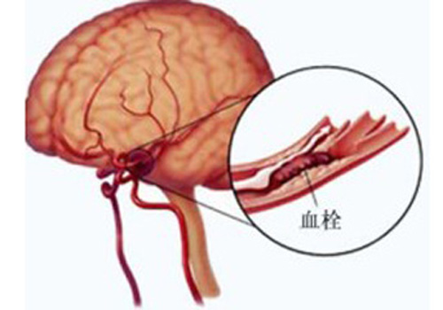 脑血栓能治好吗（突发脑血栓能治好吗）