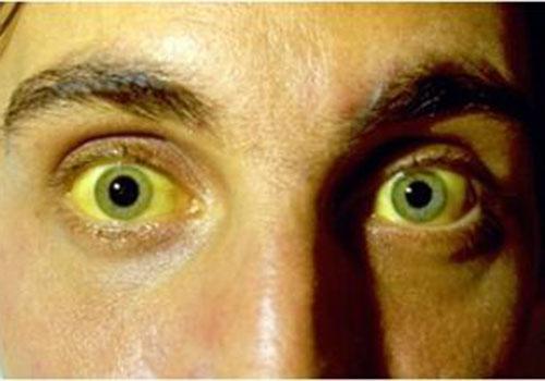 眼睛发黄是什么原因（眼睛发黄是什么原因造成的）