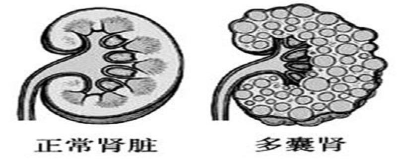 多囊肾怎么检测出来 什么叫多囊肾怎样检查