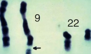 费城染色体及其临床意义是什么 费城染色体及其临床意义介绍